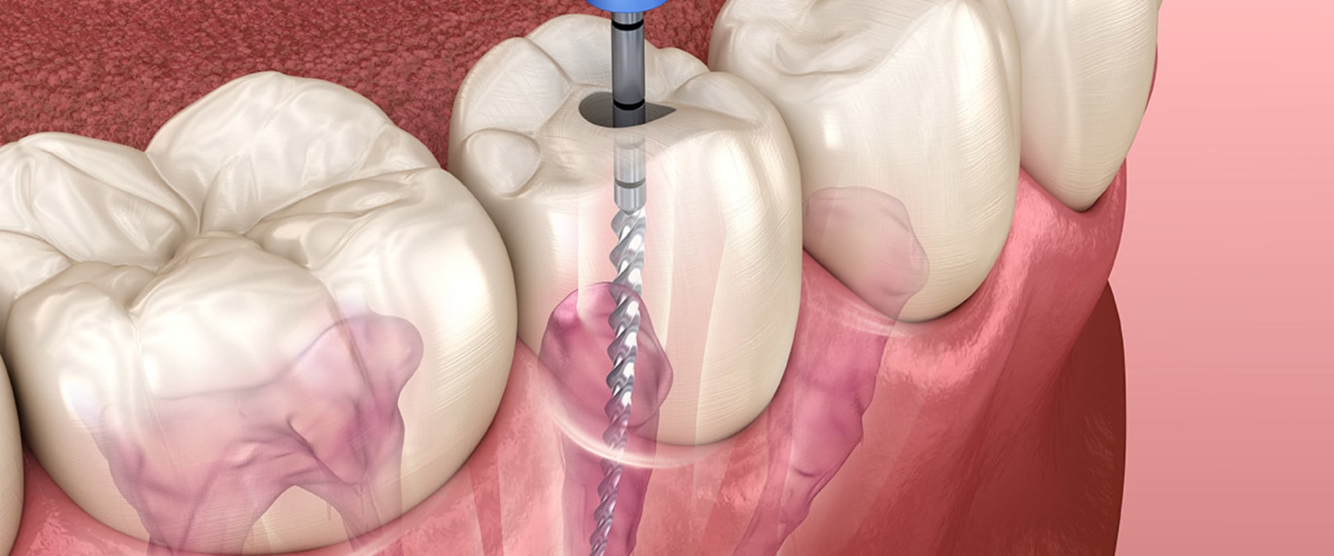 Root Canal Retreatment: A Comprehensive Guide