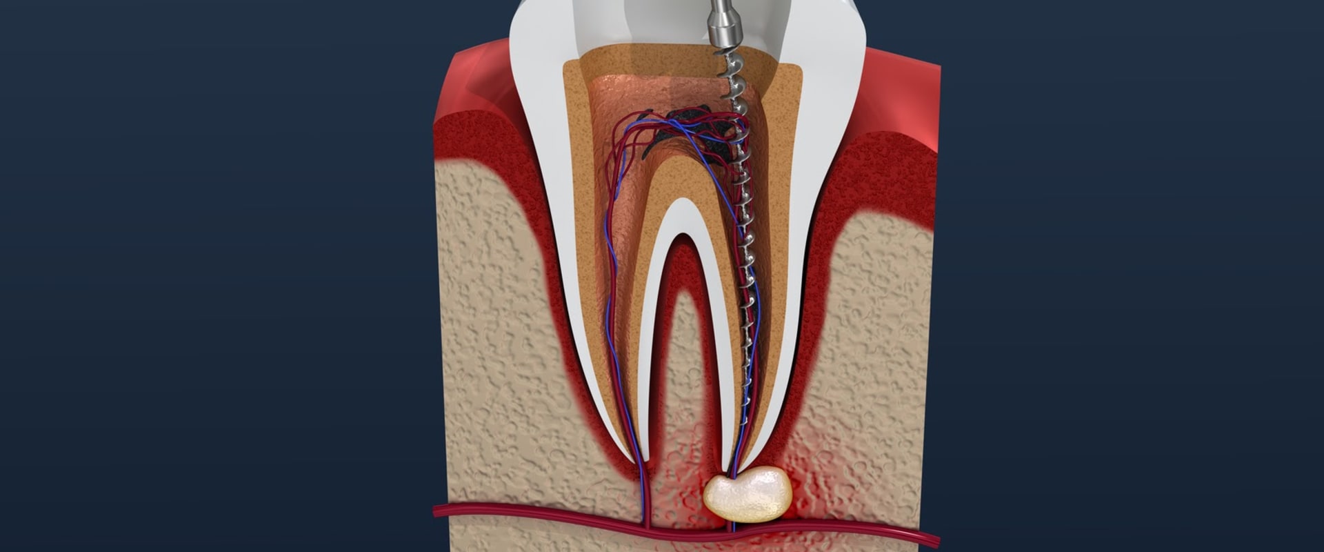 do-i-need-antibiotics-after-an-endodontic-appointment