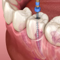 Root Canal Retreatment: A Comprehensive Guide