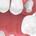 Everything You Need to Know About Dental Crowns: A Comprehensive Guide