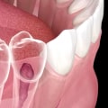 Root Canal Therapy: How Can it Save Your Teeth?