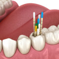 The Benefits of Endodontic Treatment: A Comprehensive Guide