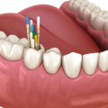 What are Endodontic Files Made Of? A Comprehensive Guide