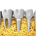 A Look Into Advanced Endodontics: Why Choose Dental Implants For Replacing Missing Teeth In Austin, TX