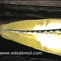 What is an Endodontic Reamer and How Does it Work?