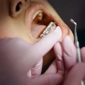Discover The Importance Of Endodontics: Unveiling The Secrets To A Healthy Smile