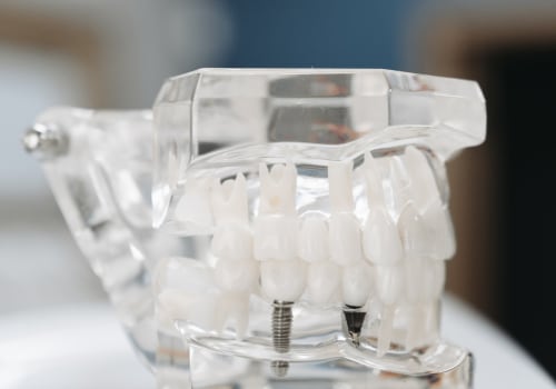 Why Should You Consider Restorative Dentistry Implants For Endodontic Treatment In Austin, TX?