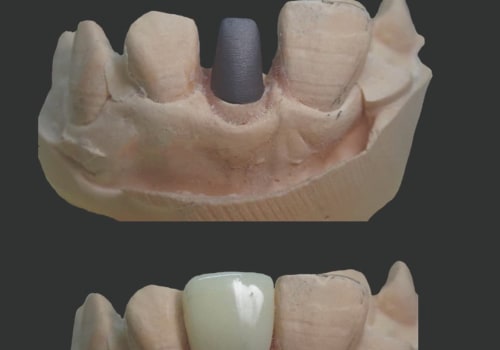 What is a Post and Core Restoration Procedure?