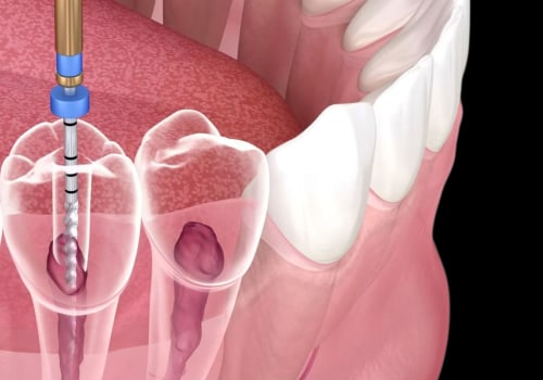 Root Canal Therapy: How Can it Save Your Teeth?