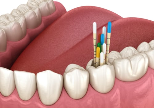 The Benefits of Endodontic Treatment: A Comprehensive Guide