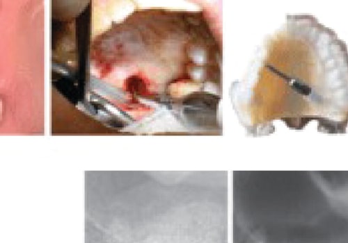 Uncovering the Benefits of Endodontic Explorers for Dentists