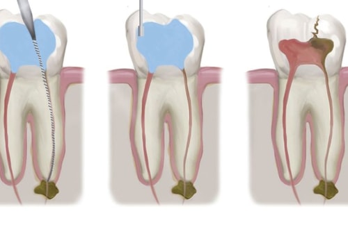 How Much Does Endodontic Treatment Cost? An Expert's Guide