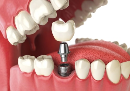 Why Endodontic Treatment Is Essential For Maintaining Your Dental Implants in Cedar Park