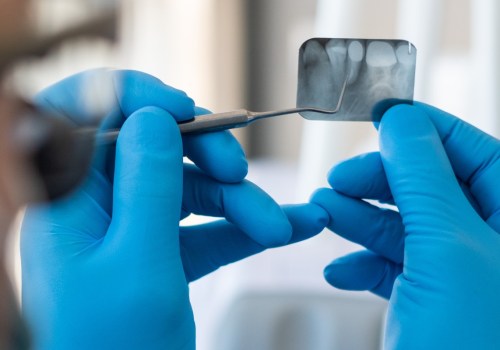 The Advantages of Endodontic Treatment: Why Preserve Your Natural Tooth